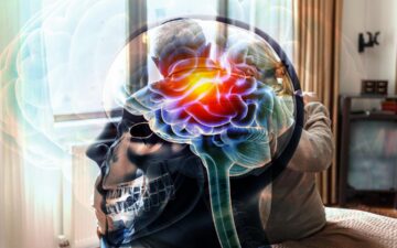 Alzheimer